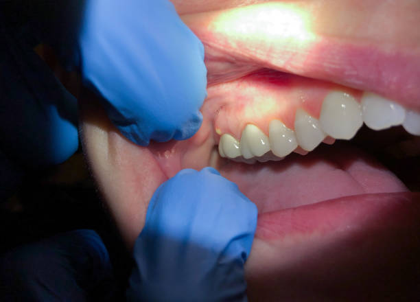 Best Emergency Dental Care for Sports Injuries in Granville, OH